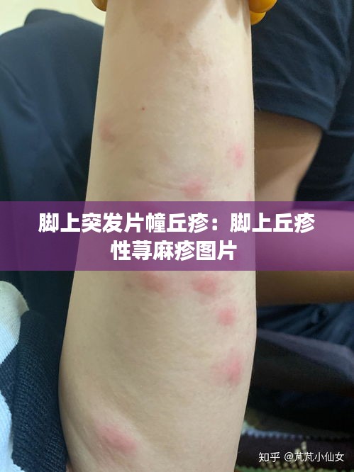 脚上突发片幢丘疹：脚上丘疹性荨麻疹图片 