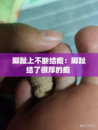 脚趾上不断结痂：脚趾结了很厚的痂 