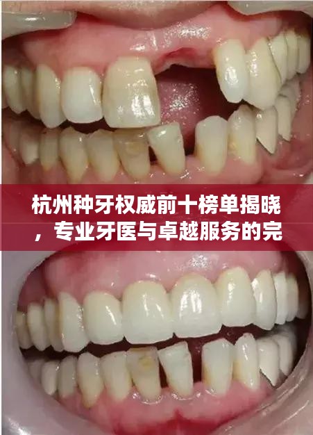 杭州种牙权威前十榜单揭晓，专业牙医与卓越服务的完美融合