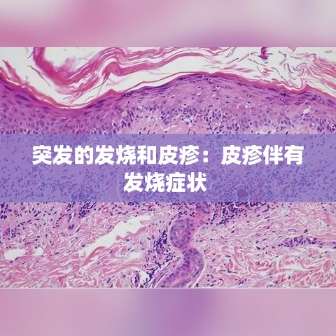 突发的发烧和皮疹：皮疹伴有发烧症状 