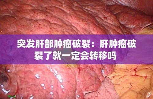 突发肝部肿瘤破裂：肝肿瘤破裂了就一定会转移吗 