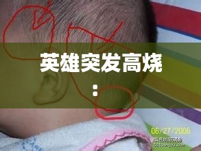 英雄突发高烧： 