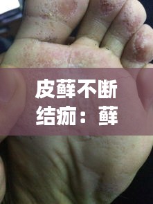 皮藓不断结痂：藓结痂了就是好了吗 