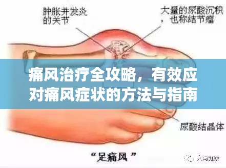 痛风治疗全攻略，有效应对痛风症状的方法与指南